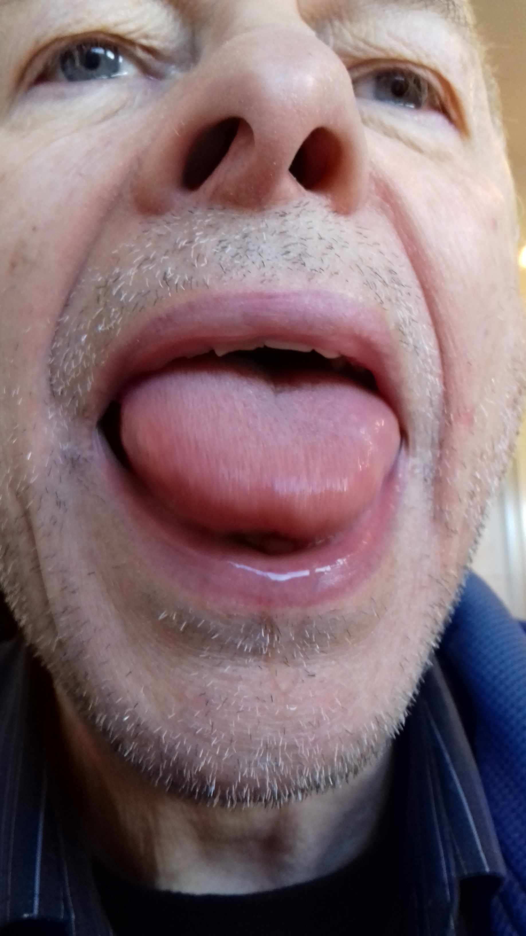 21 WTN 2018-03 Nigel Allen allergy tongue.jpg